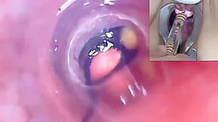 成熟女性膀胱內窺鏡內窺鏡攝像頭